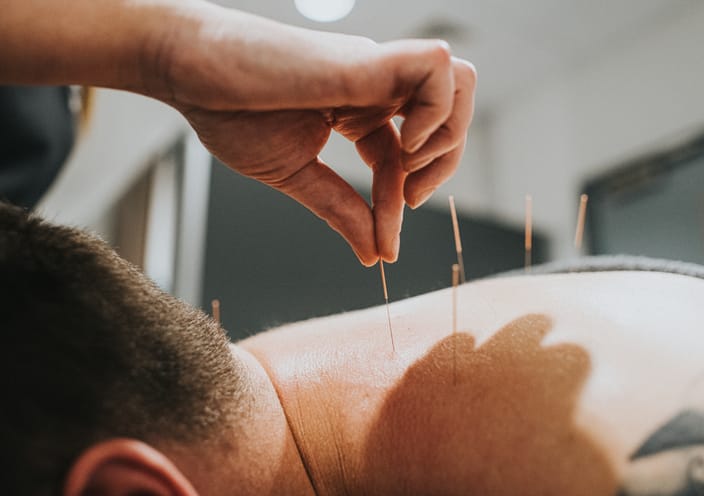 Acupuncturist inserts needles into patients back as he lies face down on a massage table.