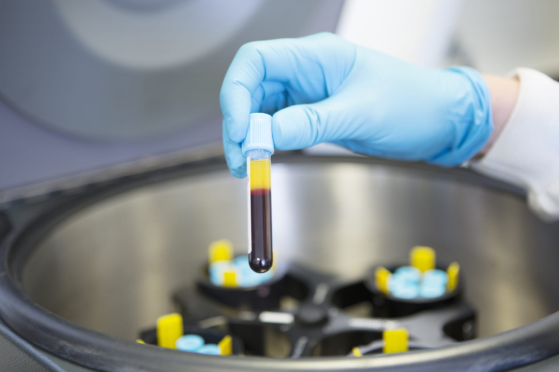 Centrifugation of blood to produce platelet plasma